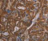 Immunohistochemistry of paraffin-embedded Human thyroid cancer tissue using CYBB Polyclonal Antibody at dilution 1:40