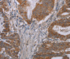 Immunohistochemistry of paraffin-embedded Human esophagus cancer tissue using NOX3 Polyclonal Antibody at dilution 1:40