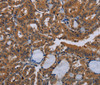 Immunohistochemistry of paraffin-embedded Human thyroid cancer tissue using NPTX1 Polyclonal Antibody at dilution 1:50