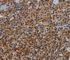 Immunohistochemistry of paraffin-embedded Human thyroid cancer tissue using DCAF6 Polyclonal Antibody at dilution 1:30