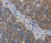 Immunohistochemistry of paraffin-embedded Human ovarian cancer tissue using OTOR Polyclonal Antibody at dilution 1:30