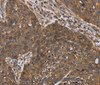 Immunohistochemistry of paraffin-embedded Human lung cancer tissue using OXTR Polyclonal Antibody at dilution 1:40