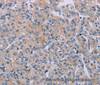 Immunohistochemistry of paraffin-embedded Human prostate cancer using P2RX3 Polyclonal Antibody at dilution of 1:50