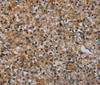 Immunohistochemistry of paraffin-embedded Human prostate cancer using TP53INP1 Polyclonal Antibody at dilution of 1:50