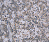 Immunohistochemistry of paraffin-embedded Human liver cancer tissue using TP53AIP1 Polyclonal Antibody at dilution 1:50