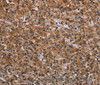 Immunohistochemistry of paraffin-embedded Human prostate cancer tissue using p70 S6 kinase beta Polyclonal Antibody at dilution 1:40