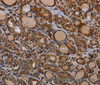 Immunohistochemistry of paraffin-embedded Human thyroid cancer using PAPPA Polyclonal Antibody at dilution of 1:50