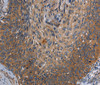 Immunohistochemistry of paraffin-embedded Human cervical cancer tissue using PARP10 Polyclonal Antibody at dilution 1:30