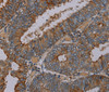 Immunohistochemistry of paraffin-embedded Human colon cancer tissue using PYY Polyclonal Antibody at dilution 1:30