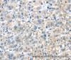Immunohistochemistry of paraffin-embedded Human liver cancer tissue using PLXNA2 Polyclonal Antibody at dilution 1:40