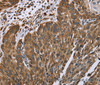 Immunohistochemistry of paraffin-embedded Human lung cancer tissue using PLXNB1 Polyclonal Antibody at dilution 1:40