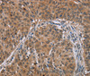 Immunohistochemistry of paraffin-embedded Human lung cancer using PMS2 Polyclonal Antibody at dilution of 1:30