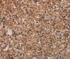 Immunohistochemistry of paraffin-embedded Human prostate cancer using PMS2 Polyclonal Antibody at dilution of 1:30