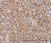 Immunohistochemistry of paraffin-embedded Human prostate cancer tissue using POMT1 Polyclonal Antibody at dilution 1:40