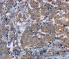 Immunohistochemistry of paraffin-embedded Human breast cancer using PON1 Polyclonal Antibody at dilution of 1:40