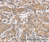 Immunohistochemistry of paraffin-embedded Human liver cancer using PPP1CC Polyclonal Antibody at dilution of 1:40