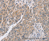 Immunohistochemistry of paraffin-embedded Human lung cancer using PPP1CC Polyclonal Antibody at dilution of 1:40