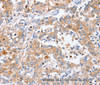 Immunohistochemistry of paraffin-embedded Human liver cancer tissue using PPOX Polyclonal Antibody at dilution 1:40
