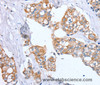 Immunohistochemistry of paraffin-embedded Human breast cancer using PTP4A2 Polyclonal Antibody at dilution of 1:30