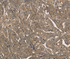 Immunohistochemistry of paraffin-embedded Human cervical cancer using PTPN12 Polyclonal Antibody at dilution of 1:45