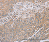 Immunohistochemistry of paraffin-embedded Human lung cancer tissue using RAB8B Polyclonal Antibody at dilution 1:45