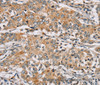 Immunohistochemistry of paraffin-embedded Human liver cancer tissue using RAB24 Polyclonal Antibody at dilution 1:45