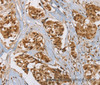 Immunohistochemistry of paraffin-embedded Human breast cancer tissue using RAB24 Polyclonal Antibody at dilution 1:45