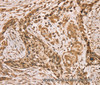 Immunohistochemistry of paraffin-embedded Human esophagus cancer using HIF1AN Polyclonal Antibody at dilution of 1:40