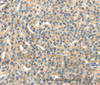 Immunohistochemistry of paraffin-embedded Human esophagus cancer tissue using RASA2 Polyclonal Antibody at dilution 1:45