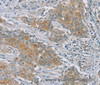 Immunohistochemistry of paraffin-embedded Human ovarian cancer tissue using RASA2 Polyclonal Antibody at dilution 1:45