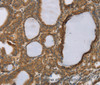 Immunohistochemistry of paraffin-embedded Human thyroid cancer using RNF5 Polyclonal Antibody at dilution of 1:35