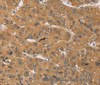 Immunohistochemistry of paraffin-embedded Human liver cancer tissue using KCNJ15 Polyclonal Antibody at dilution 1:40