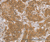 Immunohistochemistry of paraffin-embedded Human cervical cancer tissue using KCNJ15 Polyclonal Antibody at dilution 1:40