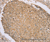 Immunohistochemistry of paraffin-embedded Human lung cancer tissue using RNF148 Polyclonal Antibody at dilution 1:45