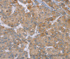 Immunohistochemistry of paraffin-embedded Human liver cancer using ACTN2 Polyclonal Antibody at dilution of 1:30