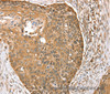 Immunohistochemistry of paraffin-embedded Human esophagus cancer using MORF4L1 Polyclonal Antibody at dilution of 1:35