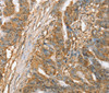 Immunohistochemistry of paraffin-embedded Human esophagus cancer tissue using SLC41A2 Polyclonal Antibody at dilution 1:45