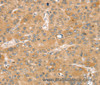 Immunohistochemistry of paraffin-embedded Human liver cancer using SNX2 Polyclonal Antibody at dilution of 1:40