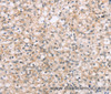 Immunohistochemistry of paraffin-embedded Human prostate cancer tissue using ROR1 Polyclonal Antibody at dilution 1:45