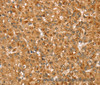 Immunohistochemistry of paraffin-embedded Human liver cancer using STX3 Polyclonal Antibody at dilution of 1:35