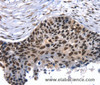 Immunohistochemistry of paraffin-embedded Human esophagus cancer using TAF15 Polyclonal Antibody at dilution of 1:35