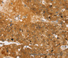 Immunohistochemistry of paraffin-embedded Human breast cancer using TBC1D4 Polyclonal Antibody at dilution of 1:40