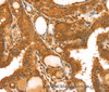 Immunohistochemistry of paraffin-embedded Human thyroid cancer tissue using TRIM25 Polyclonal Antibody at dilution 1:40
