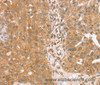 Immunohistochemistry of paraffin-embedded Human breast cancer tissue using TRIM25 Polyclonal Antibody at dilution 1:40