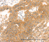 Immunohistochemistry of paraffin-embedded Human breast cancer tissue using TMEFF2 Polyclonal Antibody at dilution 1:35