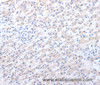 Immunohistochemistry of paraffin-embedded Human liver cancer using ALDH1A1/2/3 Polyclonal Antibody at dilution of 1:40