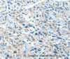 Immunohistochemistry of paraffin-embedded Human esophagus cancer tissue using BAD Polyclonal Antibody at dilution 1:60