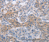 Immunohistochemistry of paraffin-embedded Human lung cancer tissue using CASP10 Polyclonal Antibody at dilution 1:30