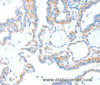 Immunohistochemistry of paraffin-embedded Human thyroid cancer tissue using TLR2 Polyclonal Antibody at dilution 1:55