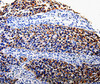 Immunohistochemistry of paraffin-embedded Human renal cancer tissue using COX10 Polyclonal Antibody at dilution 1:100